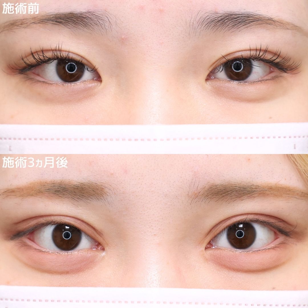 上眼瞼切開術/目頭切開術の症例写真 施術前後 